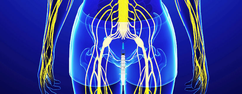 patient receiving Caudal Epidural Steroid Injections in Allen for auto accident injury pain relief