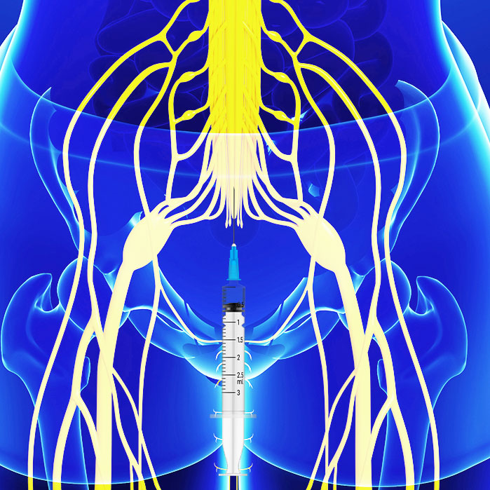 caudal epidural steroid injections in Allen