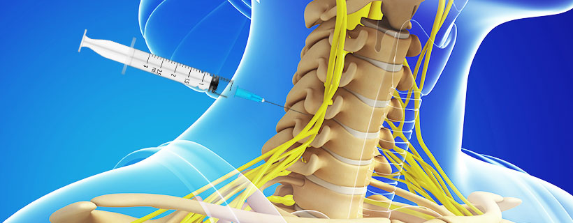 patient receiving Cervical Epidural Steroid Injections in Allen for auto accident injury pain relief