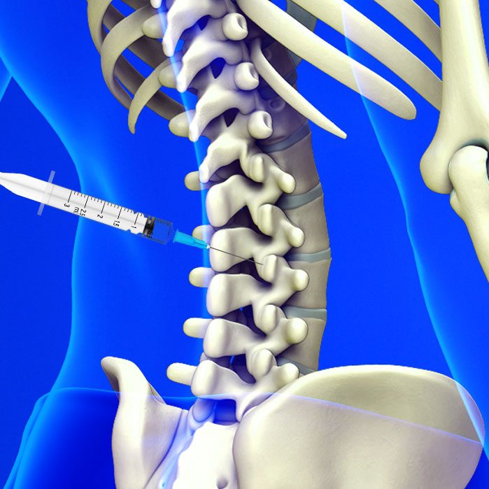 facet joint injections in Allen