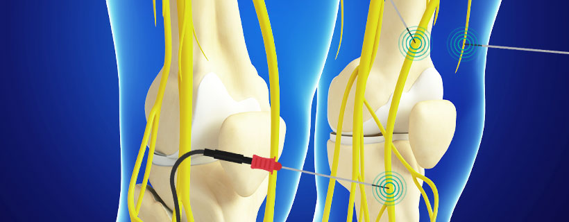 patient receiving Genicular Nerve Ablation in Allen for auto accident injury pain relief