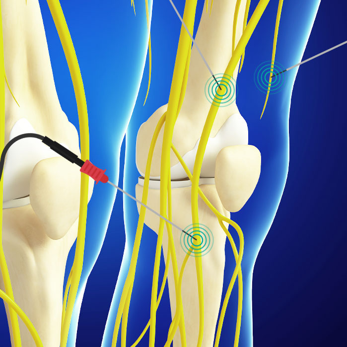 genicular nerve ablation in Allen