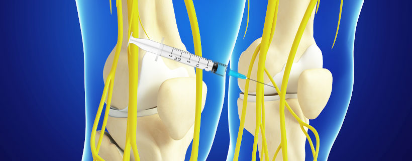 patient receiving Genicular Nerve Block in Allen for auto accident injury pain relief