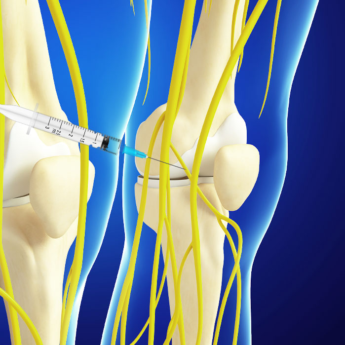 genicular nerve block in Allen