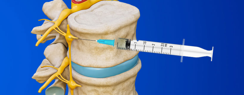 patient receiving Lumbar Sympathetic Block in Allen for auto accident injury pain relief