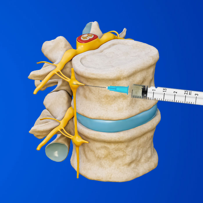 lumbar sympathetic block in Allen