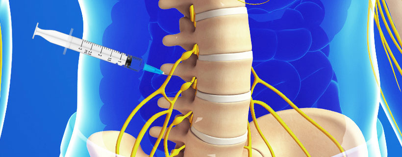 patient receiving Lumbar Transforaminal Epidural Steroid Injections in Allen for auto accident injury pain relief