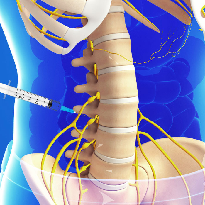 lumbar transforaminal epidural steroid injections in Allen