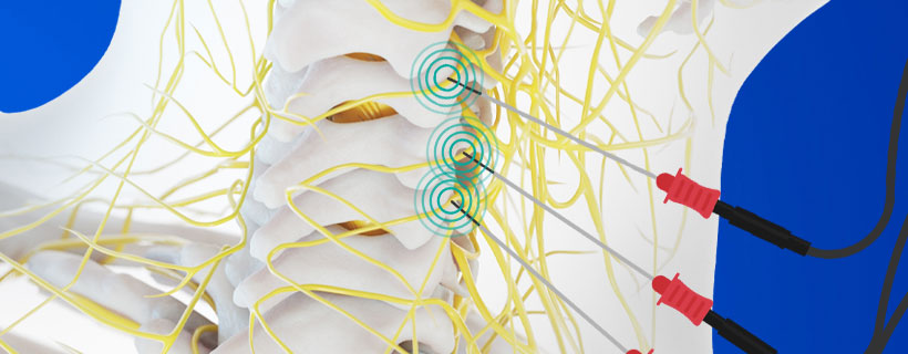 patient receiving Radiofrequency Neurotomy in Allen for auto accident injury pain relief