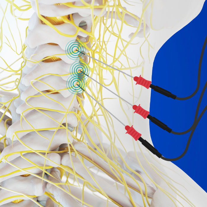radiofrequency neurotomy in Allen