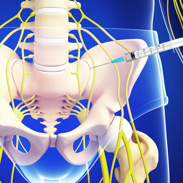 sacroiliac joint steroid injections in Allen