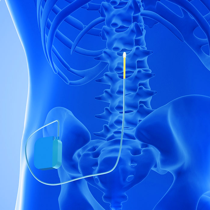spinal cord stimulator implant in Allen