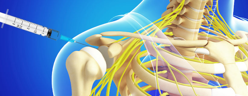 patient receiving Subacromial Injections in Allen for auto accident injury pain relief