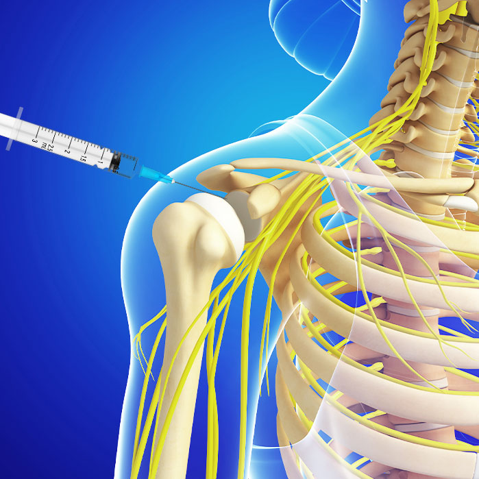 subacromial injections in Allen