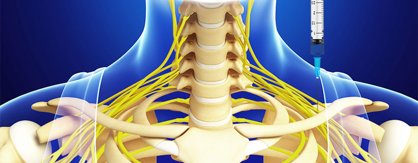 patient receiving Suprascapular Nerve Block in Allen for auto accident injury pain relief