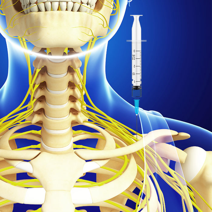 suprascapular nerve block in Allen