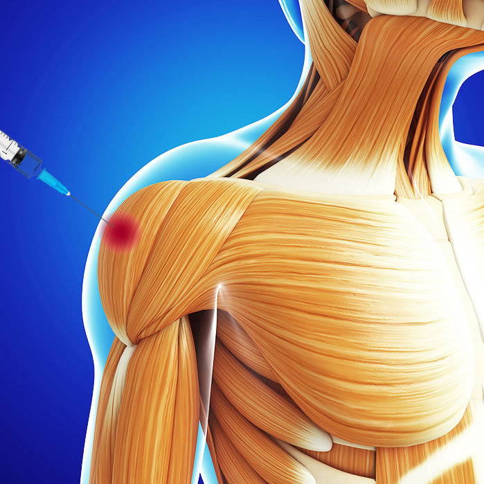 trigger point injections in Allen