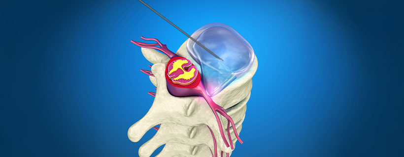 patient receiving YESS Endoscopic Discectomy in Allen for auto accident injury pain relief