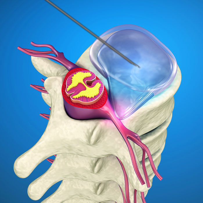 yess endoscopic discectomy in Allen